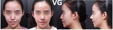before-after photo septoplasty