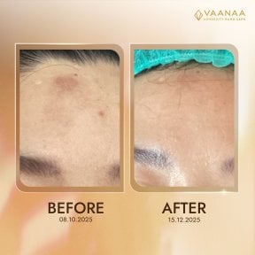 Before and after stem cell rejuvenation therapy results at VAANAA LONGEVITY BANGSAEN, forehead skin