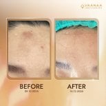Before and after stem cell rejuvenation therapy results at VAANAA LONGEVITY BANGSAEN, forehead skin