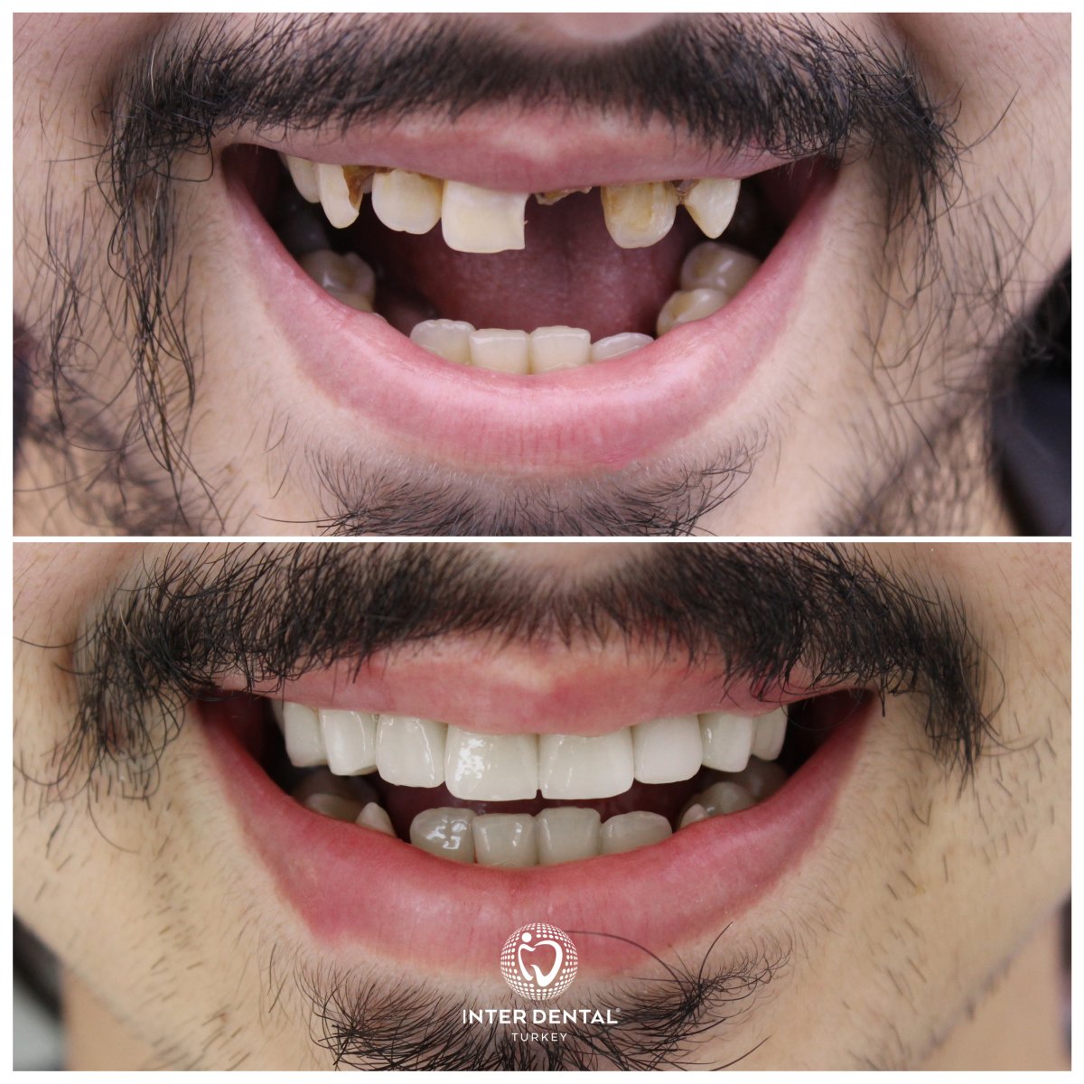 نتائج قبل وبعد تركيب تيجان الزركونيا في Inter Dental Turkey – ابتسامة جديدة