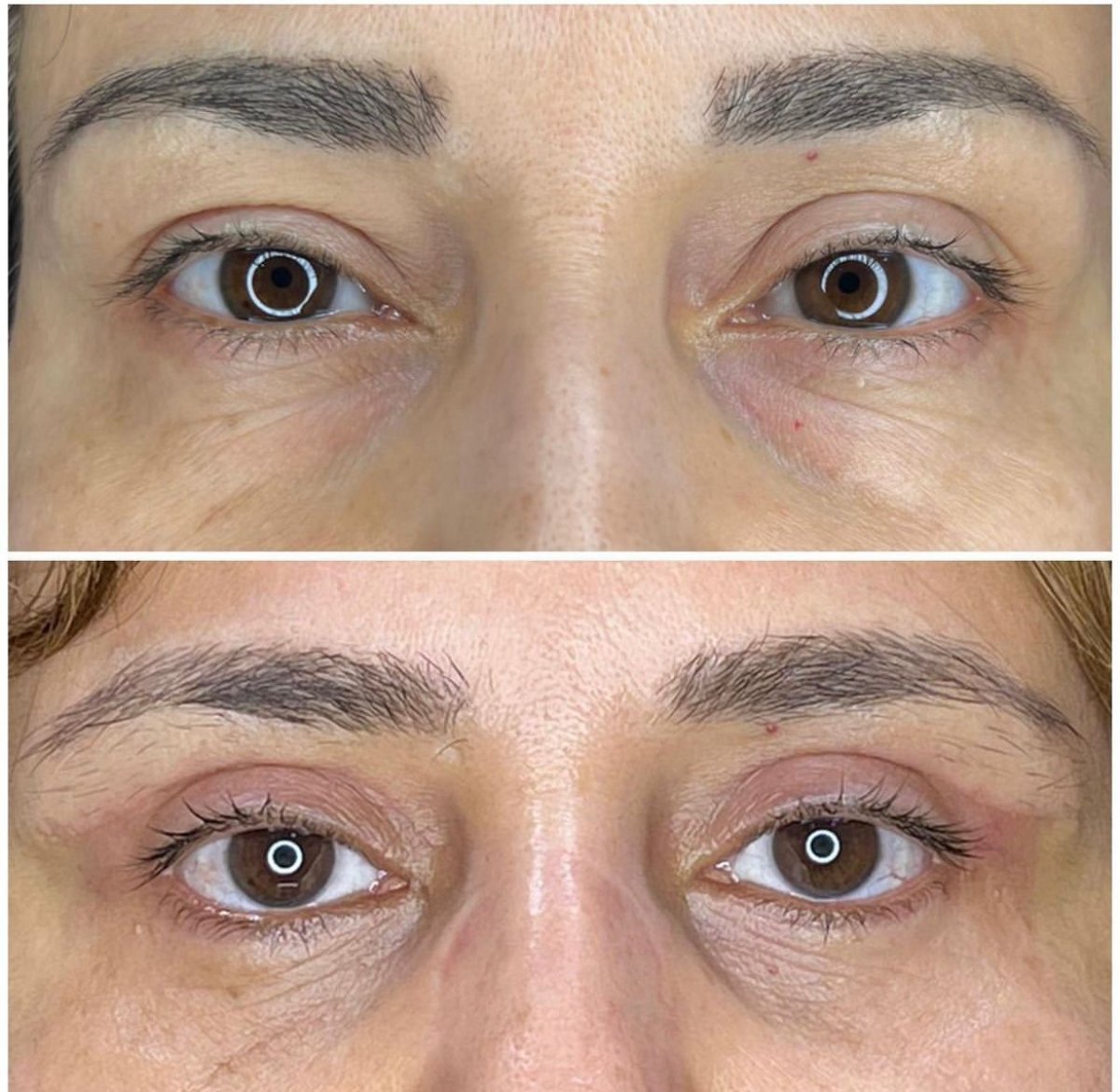 Resultados de blefaroplastia antes y después en Private Yüzyıl Hospital, corrección de párpados