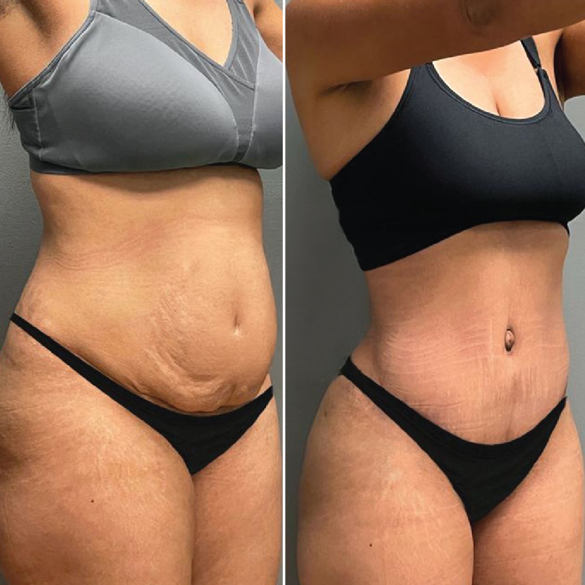 Resultados de liposucción antes y después en Private Yüzyıl Hospital, contorno abdominal mejorado