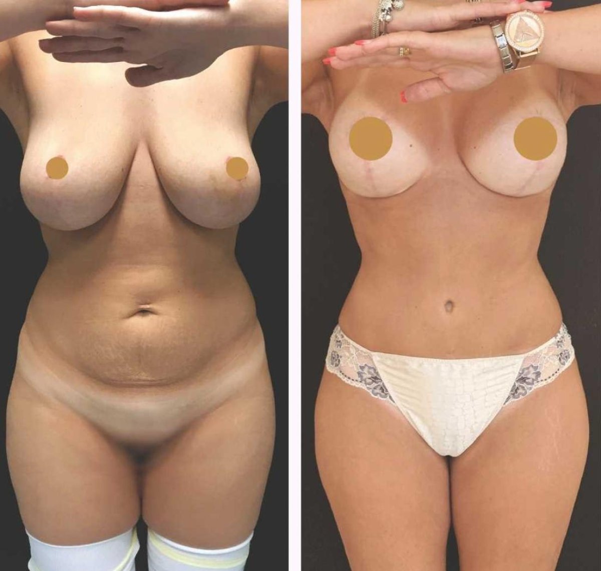 Resultados antes y después de mommy makeover en Private Yüzyıl Hospital – mejora corporal