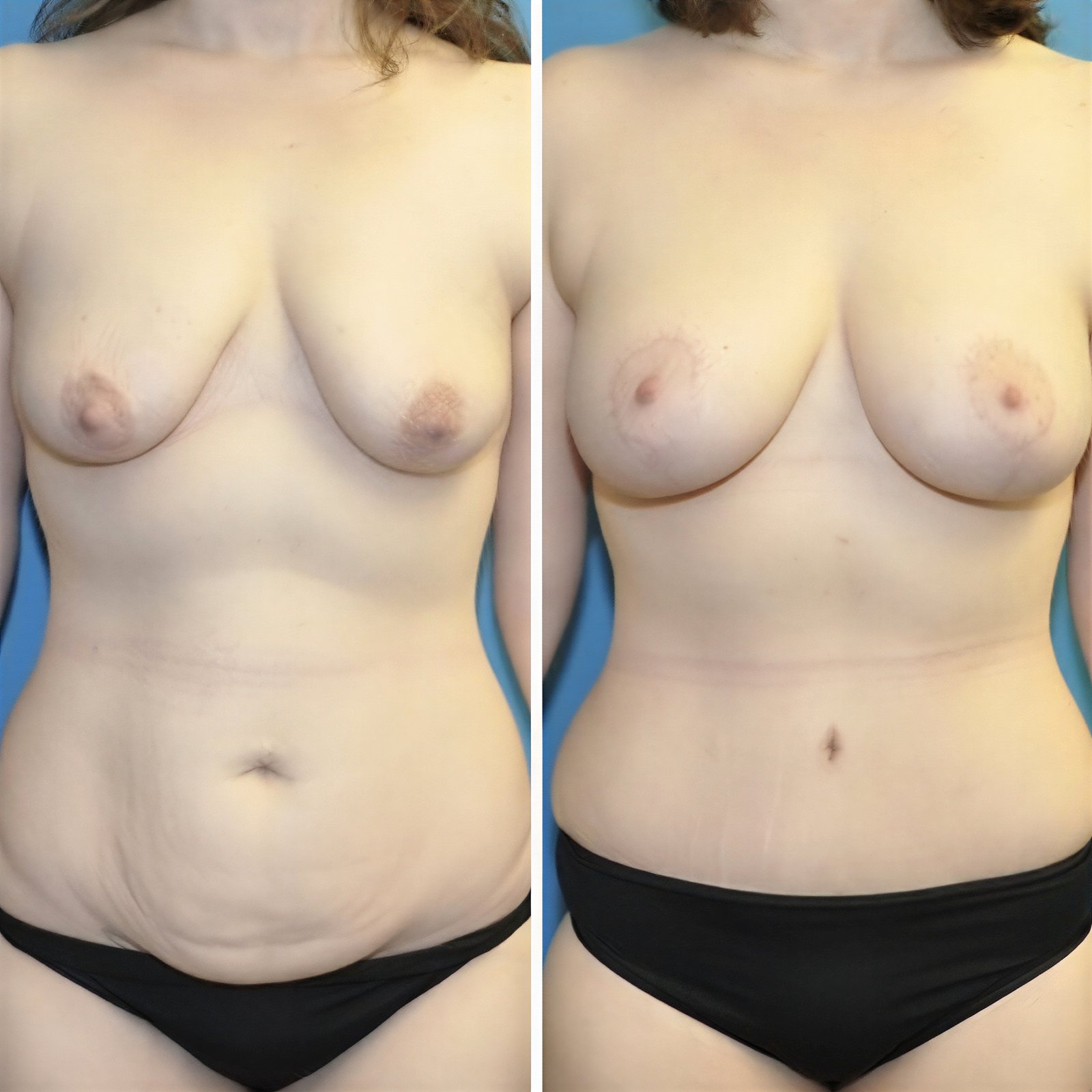 نتائج قبل وبعد عملية تجميل الأم في مستشفى Private Yüzyıl، تحسين شكل الجسم