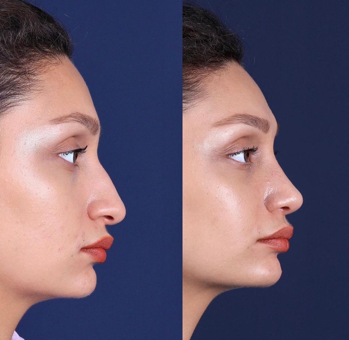Resultados de rinoplastia antes y después en Private Yüzyıl Hospital, perfil nasal mejorado