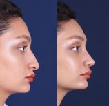 Resultados de rinoplastia antes y después en Private Yüzyıl Hospital, perfil nasal mejorado