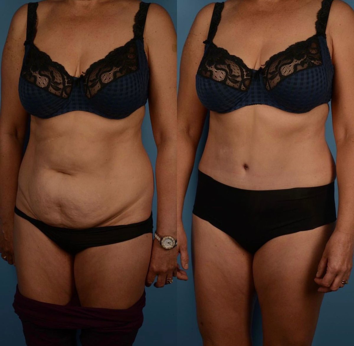 Resultados de abdominoplastia antes y después en Private Yüzyıl Hospital, abdomen mejorado