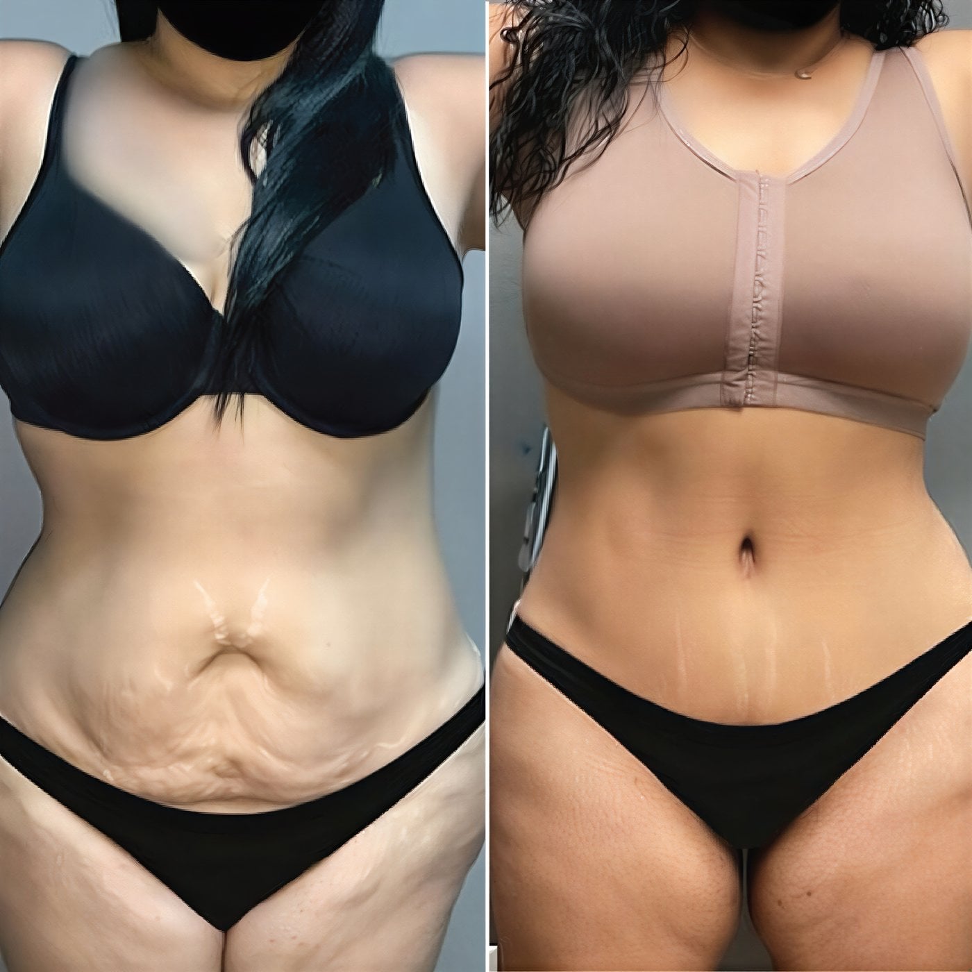 Resultados de abdominoplastia antes y después en Private Yüzyıl Hospital, abdomen mejorado