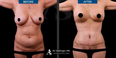before-after photo korrekcia-figury-mommy-makeover
