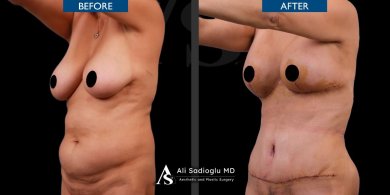 before-after photo korrekcia-figury-mommy-makeover