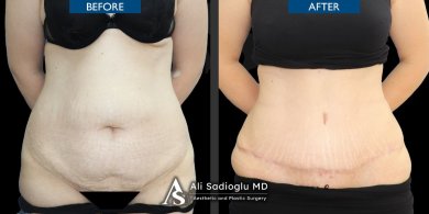 before-after photo korrekcia-figury-mommy-makeover