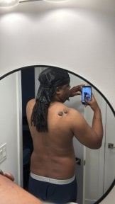 before-after photo scar-revision