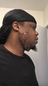 before-after photo scar-revision
