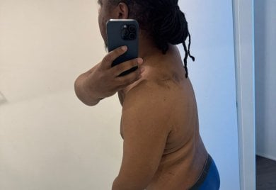 before-after photo scar-revision