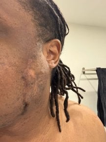 before-after photo scar-revision