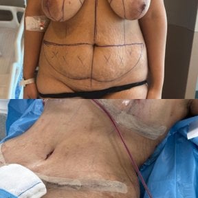 before-after photo abdominoplasty