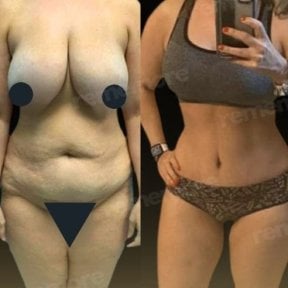before-after photo abdominoplasty