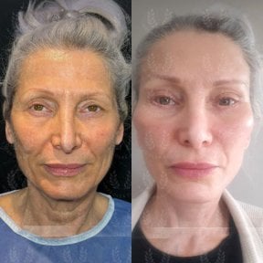 before-after photo tightening-of-facial-skin-facelift