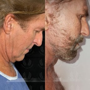 before-after photo glubokaya-podtyazhka-lica-deep-plane-facelift