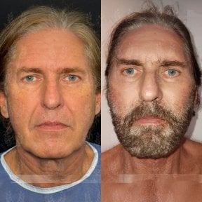before-after photo glubokaya-podtyazhka-lica-deep-plane-facelift