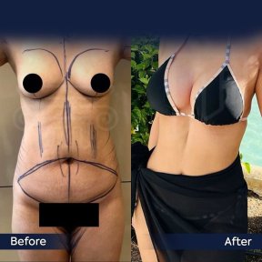 before-after photo korrekcia-figury-mommy-makeover
