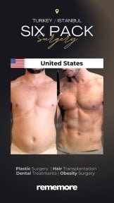 before-after photo abdominal-etching