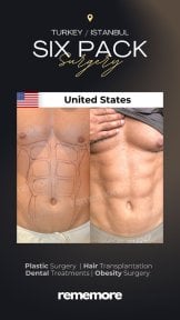before-after photo abdominal-etching