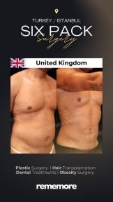 before-after photo abdominal-etching