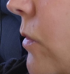 before-after photo lip-lift