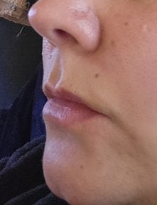 before-after photo lip-lift