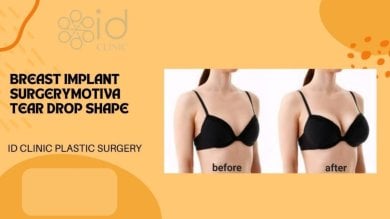 before-after photo breast-implant-revision