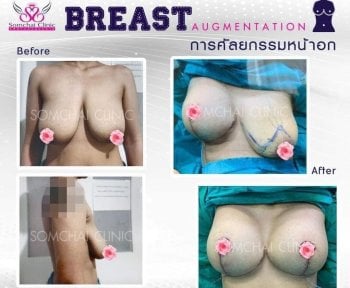 before-after photo mommy-makeover