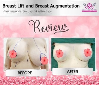 before-after photo mommy-makeover