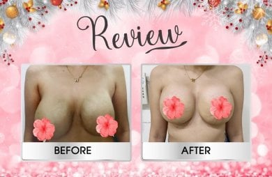 before-after photo mommy-makeover