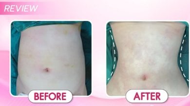 before-after photo mommy-makeover
