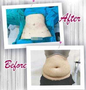 before-after photo mommy-makeover