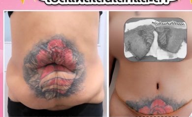 before-after photo mommy-makeover