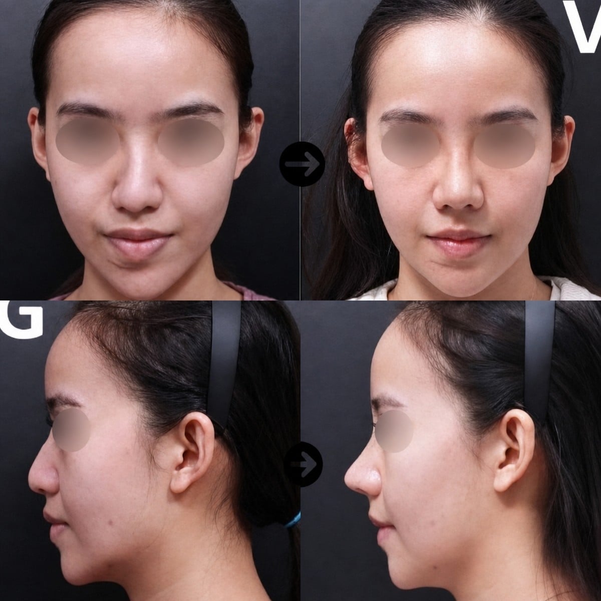 نتائج قبل وبعد عملية تصحيح الحاجز الأنفي في VG Plastic Surgery، تحسين تنفس وتناسق الأنف