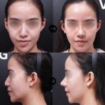 Результати септопластики до і після у VG Plastic Surgery, покращена симетрія носа та дихання