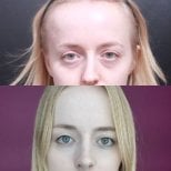 Результати септопластики до і після у VG Plastic Surgery, покращена симетрія та дихання