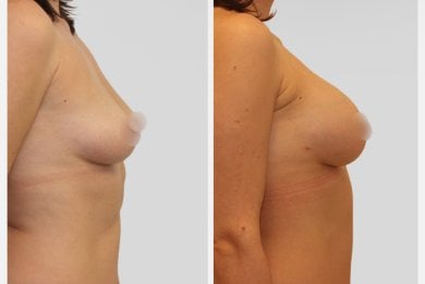 Vorher-nachher-Ergebnis Brustimplantate mit Straffung – verbesserte Form und Volumen