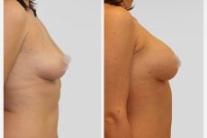 Vorher-nachher-Ergebnis Brustimplantate mit Straffung – verbesserte Form und Volumen