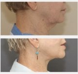 Vorher-nachher-Ergebnis Deep Plane Facelift – verbesserte Kiefer- und Halspartie
