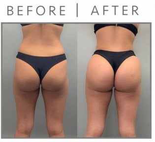 before-after photo abdominoplasty