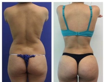 before-after photo abdominoplasty