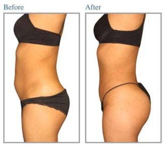 before-after photo abdominoplasty