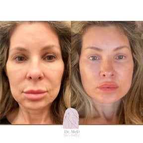 before-after photo tummy-tuck-and-liposuction