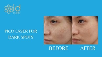 before-after photo skin-rejuvenation
