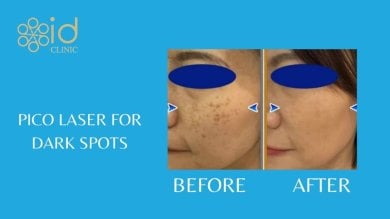 before-after photo skin-rejuvenation