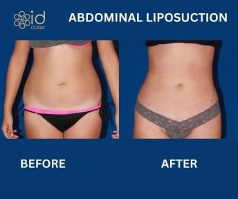 before-after photo 360-liposuction